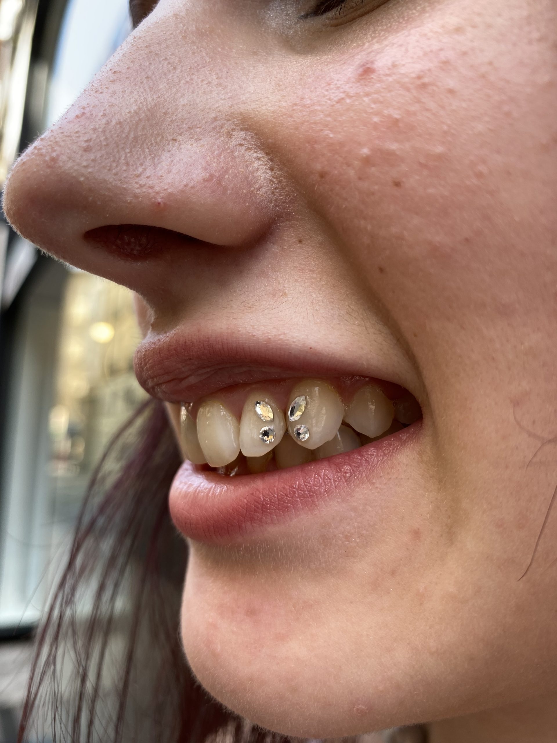 Gema dental en forma de mariposa