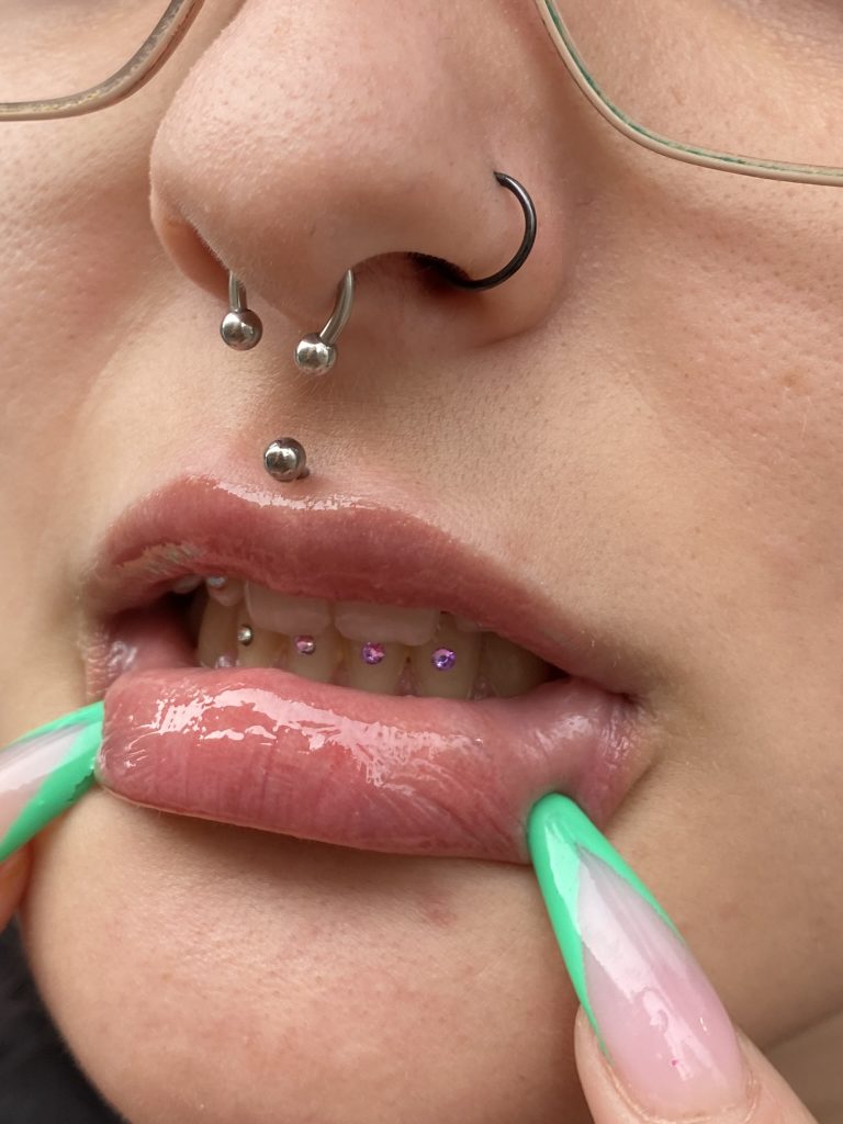 Composición de gemas dentales en forma de bracket en los dientes bajos